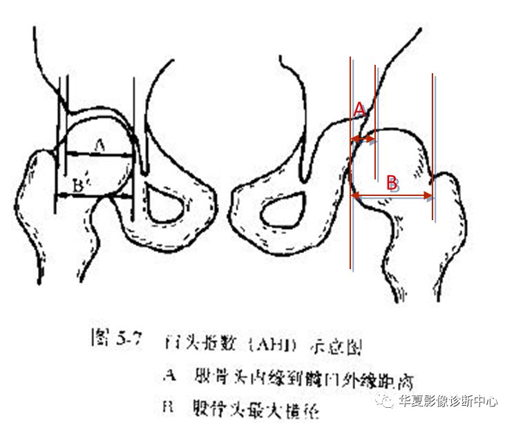 先天性髋关节脱位饮食,先天性髋关节脱位属不属于残疾人