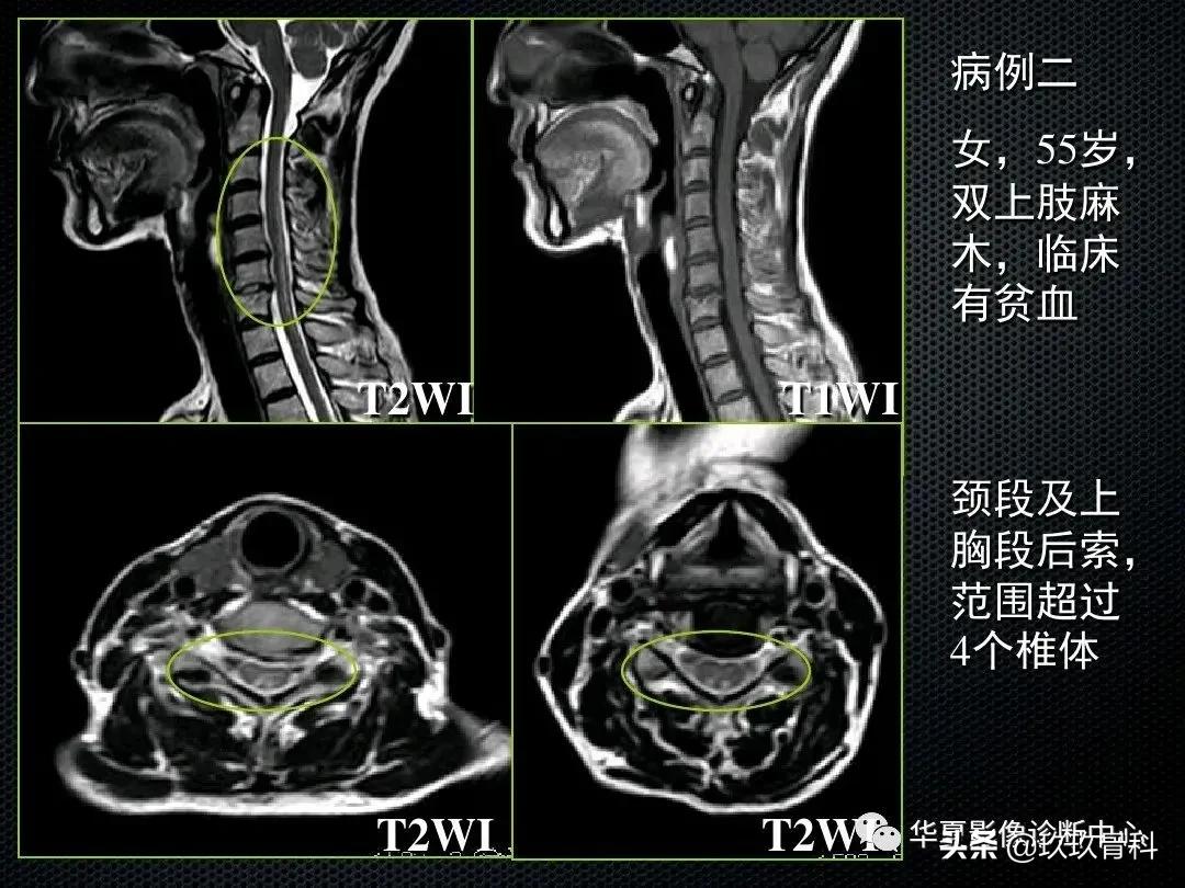 颈椎病脊髓变性mri表现,脊髓亚急性联合变性的诊断