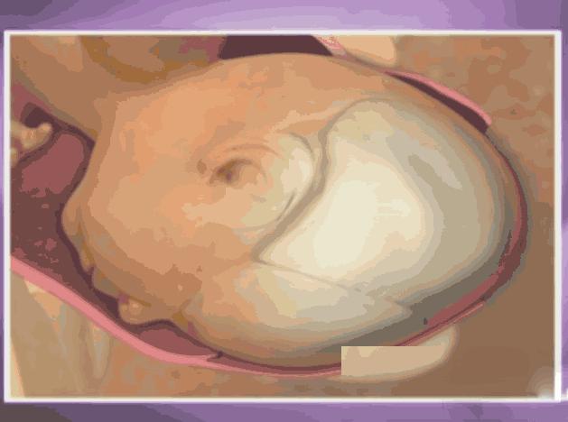 胎儿双顶径偏大可以顺产吗,胎儿双顶径超过10cm可以顺产吗