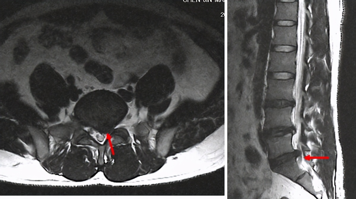 腰椎间盘突出吃什么药有效,得了腰椎间盘突出怎么办