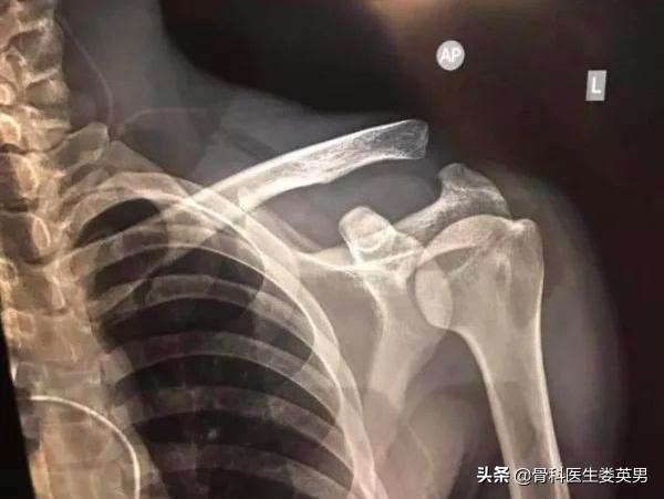 武磊左肩骨错位韧带撕裂,武磊首次回应左肩伤势