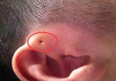婴儿耳朵有个肉球什么时候能去掉,宝宝耳朵长小肉球要几岁动手术