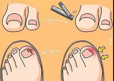 啃指甲拔倒刺可能会引起甲沟炎,啃手指啃出甲沟炎