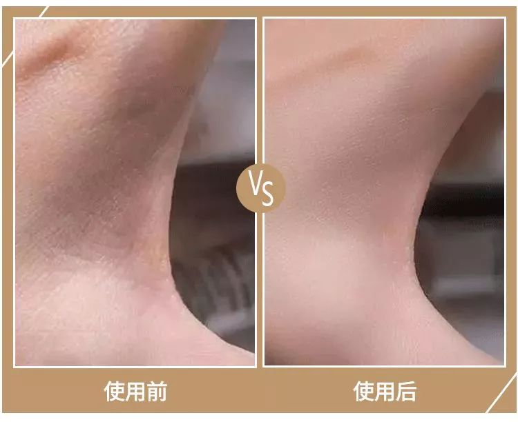 擦手霜保湿干裂起皮,冬季手干裂粗糙小妙招