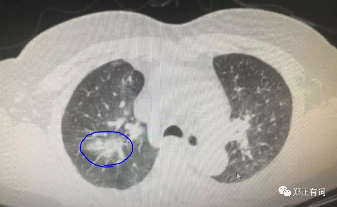心肺功能特别差能动肺手术吗,肺癌想做手术呼吸功能差怎么办