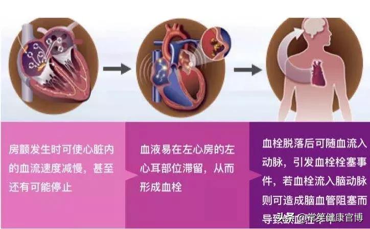 欧洲房颤指南,房颤最新指南解读