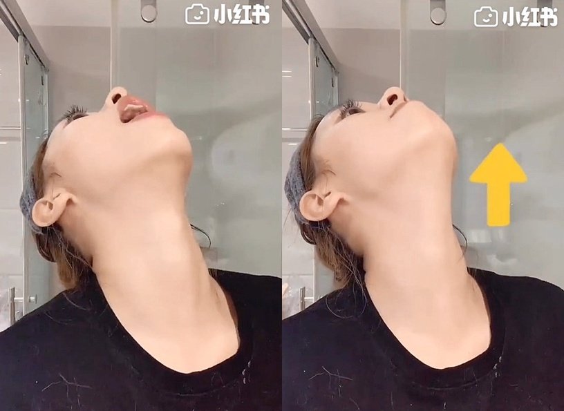 练精致下颚线,徐睿知脸部提升