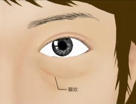 泪沟都到脸颊了怎么办,泪沟眼袋越来越严重怎么办