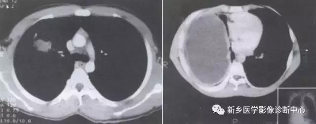 肺部有球形病灶怎么治疗,肺内多发结节诊断早期肺癌怎么办