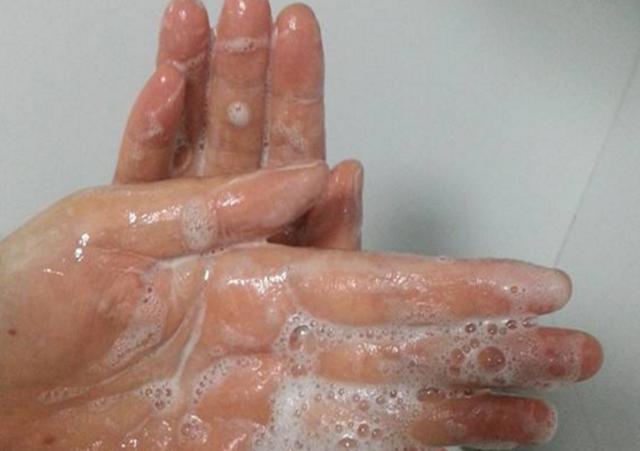 为了避免手上起水泡该怎么预防,一到天热手上起水泡脱皮