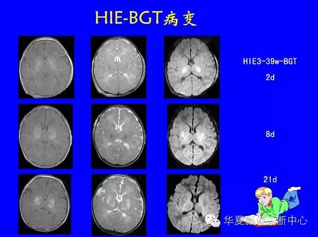 新生儿颅脑mri,新生儿颅脑mr报告模板