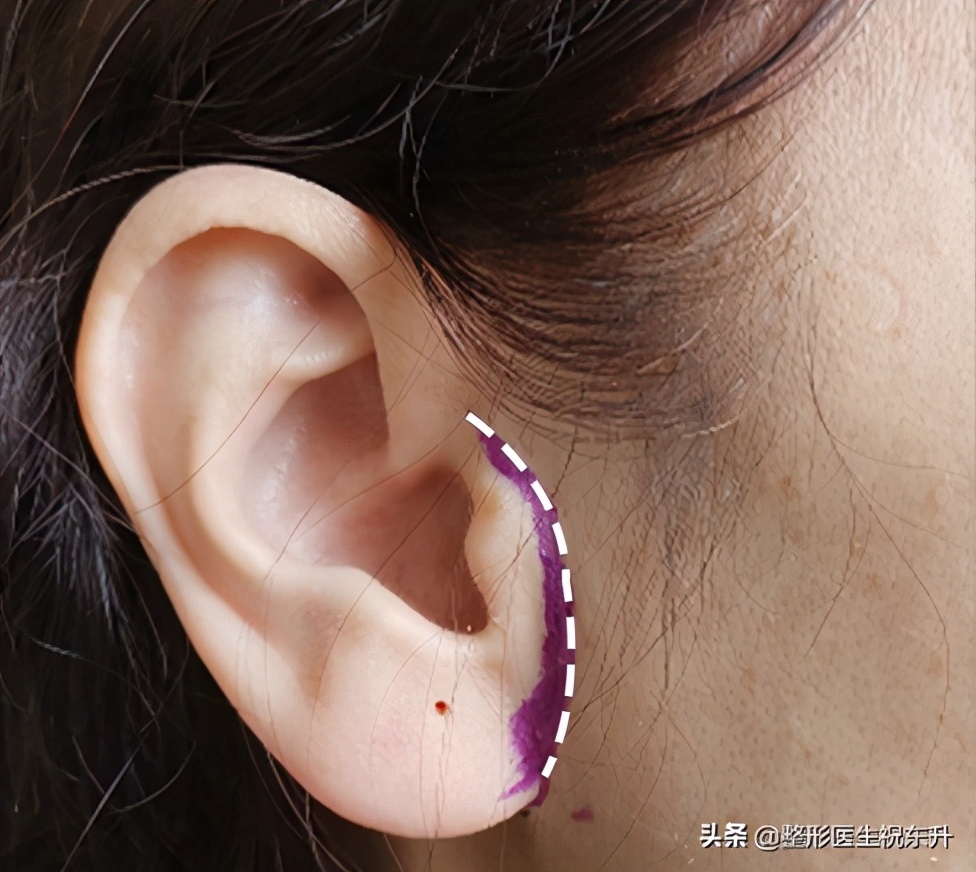 四十岁做拉皮的疤要多久会修复,拉皮手术后的疤痕处怎么修复