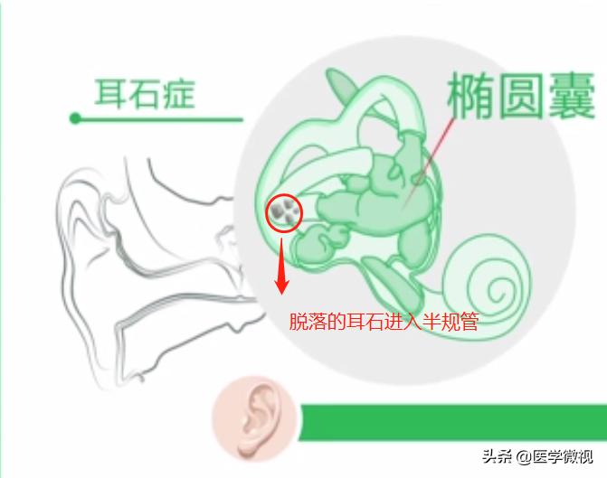 耳石的恢复方法,耳屎和耳石的区别