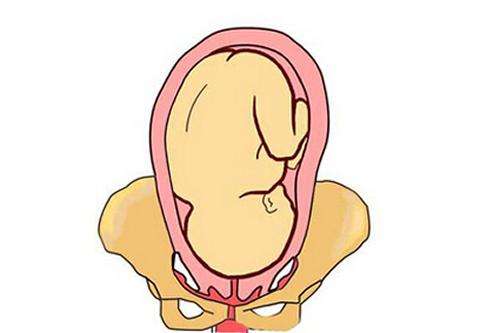 难产按肚子伸手转胎位,怀孕按压肚子导致流产