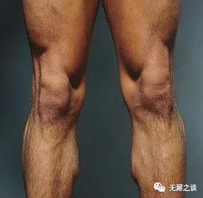 问答｜长期跑步如何保护膝盖？