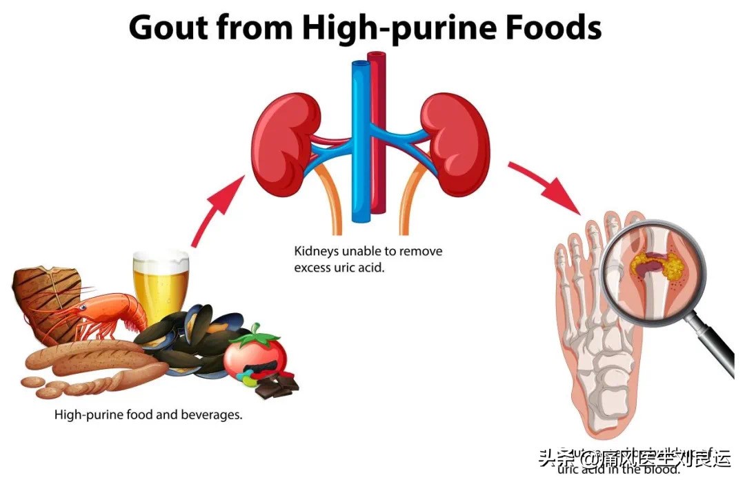 我和我20多年的婚姻，因为痛风20年的丈夫长出痛风石遭遇考验