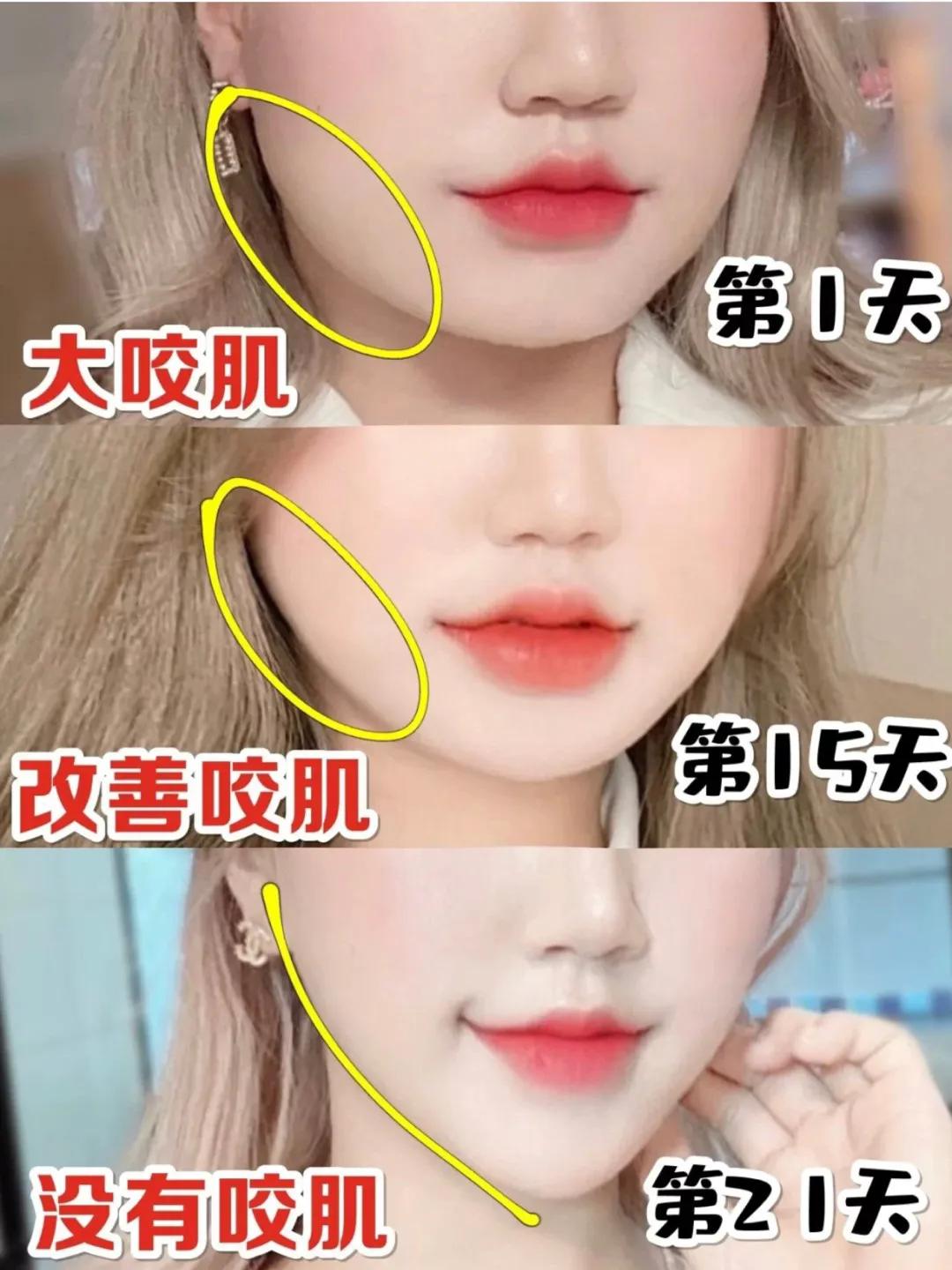 瘦脸咬肌完全消下去,咬肌瘦脸