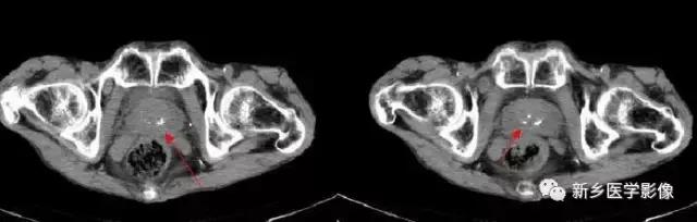 左肾可见高密度影不是结石,结节状高密度影是结石吗