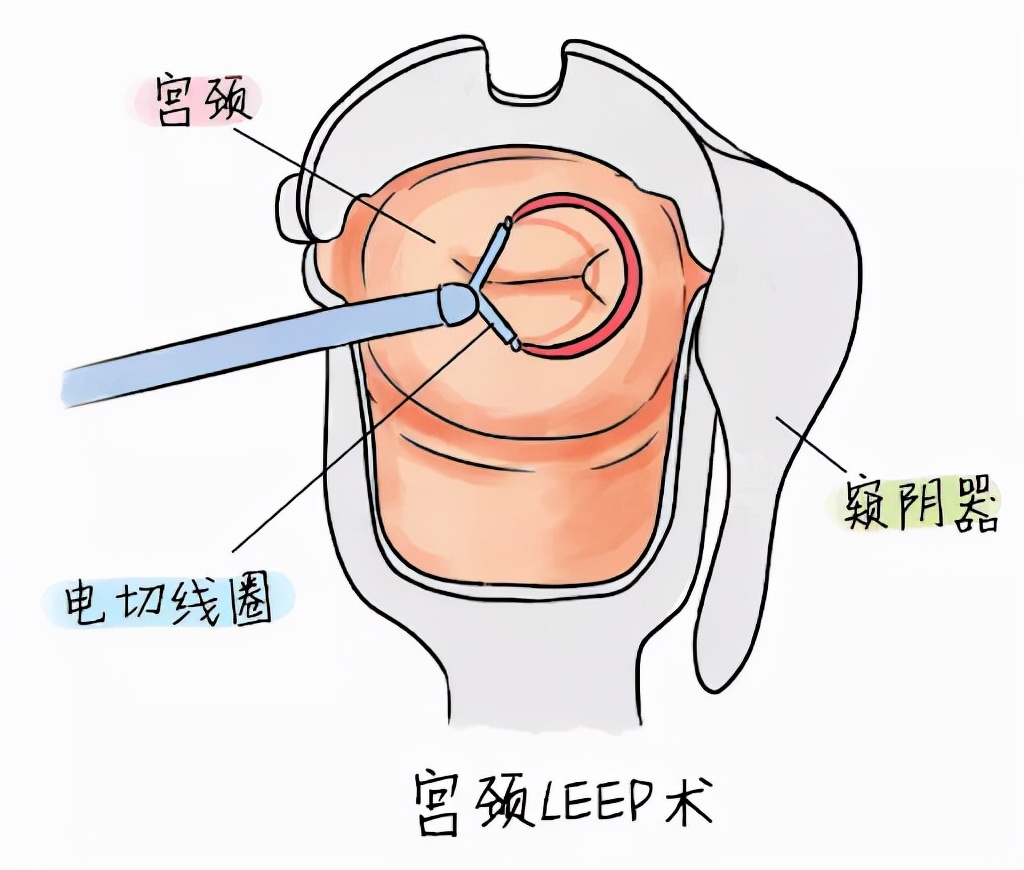 hpv感染需要做leep手术吗,我在美国的求医经历