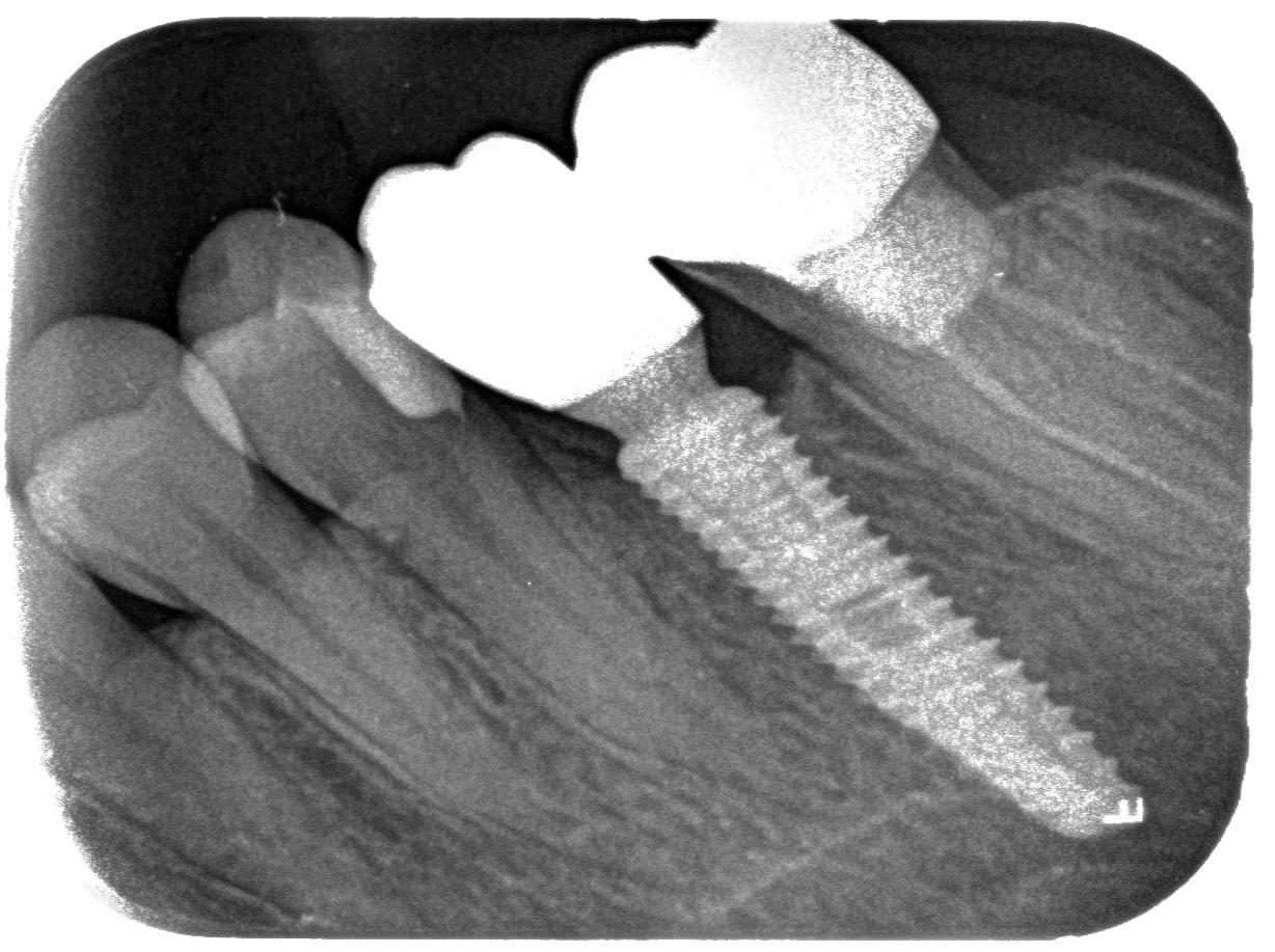 种植牙手术流程图解,口腔种植牙护士手术配台流程