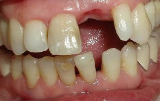 上门牙掉了一块怎么修复,牙磕碰掉了一小块怎么修复