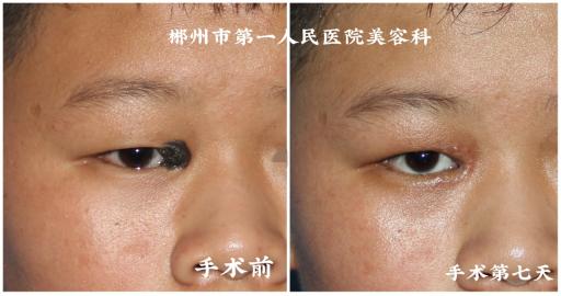 脸上太多痣了怎么能让它自动消失,脸上痣太多怎么在家去除