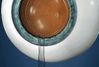 近视度数高戴眼镜怎么好看,近视了但是戴眼镜很丑怎么办