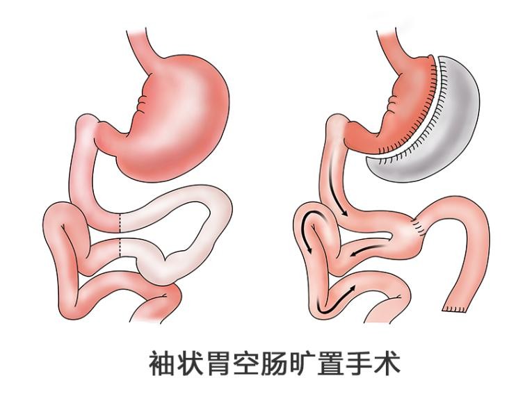 切胃减肥手术后病友真实反馈,为减肥切胃
