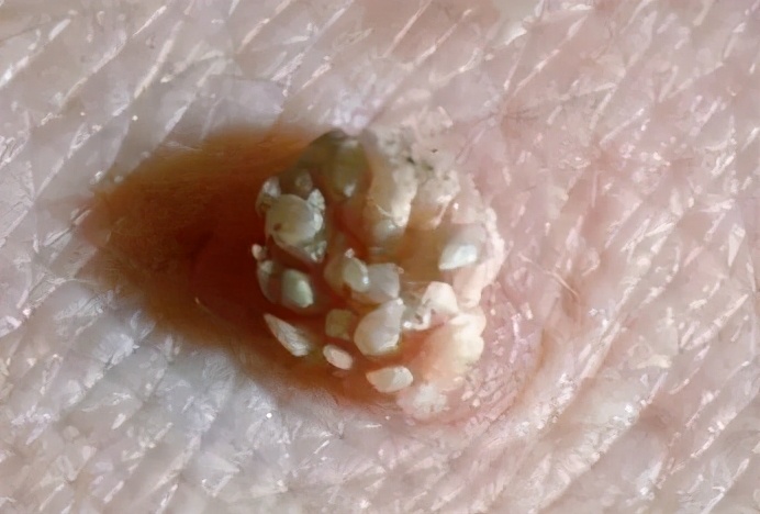 体表长肉疙瘩是病吗,私部长疮是什么病