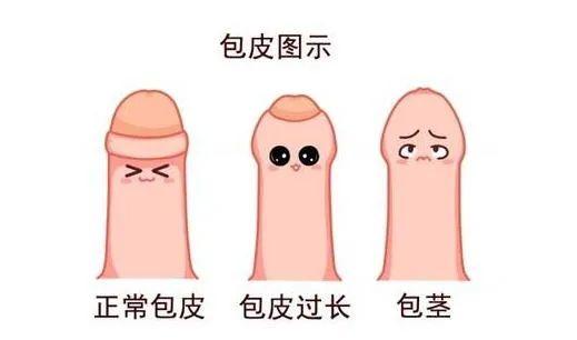 暑期孩子割包皮需要住院吗,暑期到要不要给孩子割包皮呢