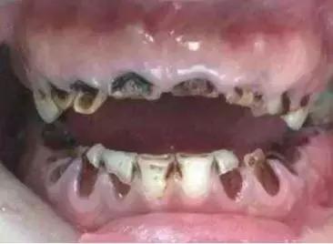 吓！10岁小孩就要靠假牙吃饭，妈妈记住这9招保护好孩子的牙