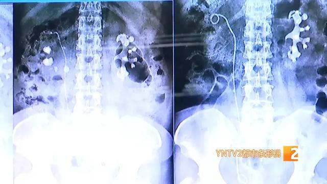 双肾多发结石取出2000多颗,史上最大手术取出肾结石