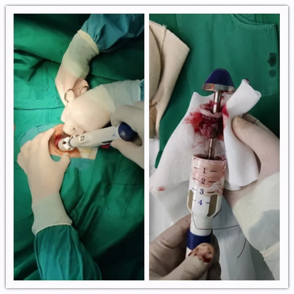 【科室之窗】疼痛？便血？脱出？PPH微创手术为您解除难言之隐