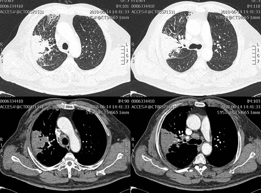 如何发现肺部真菌感染,怎样早期识别真菌感染