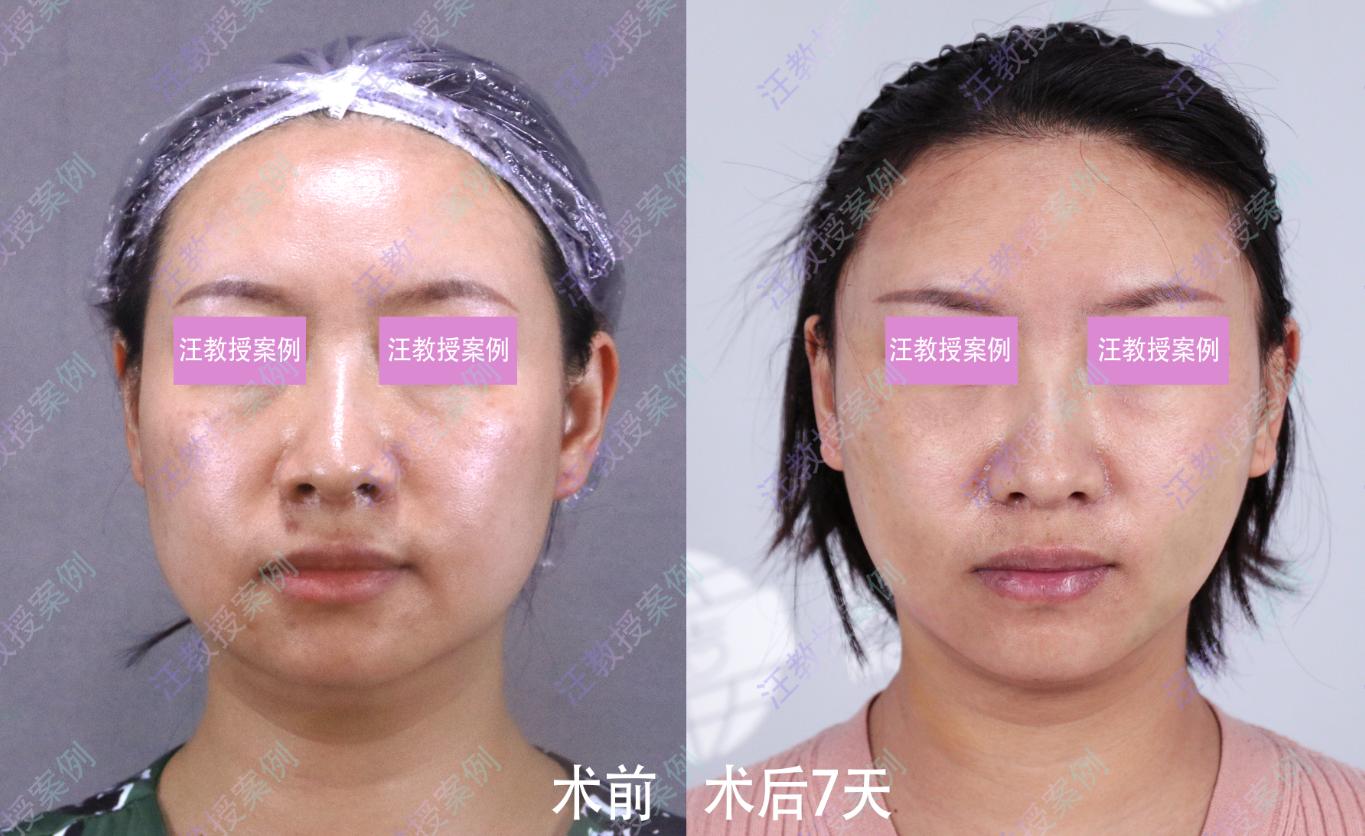 微创拉皮结合线雕,线雕和微创拉皮哪个好