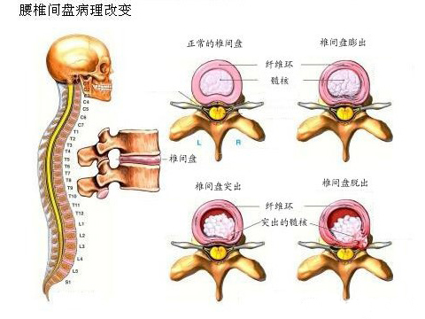 腰椎间盘突出脱出膨出的区别,腰椎间盘膨出和突出的中医治疗