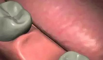 3d打印种植牙与传统种植牙的区别,种植牙是怎样种植的如何操作