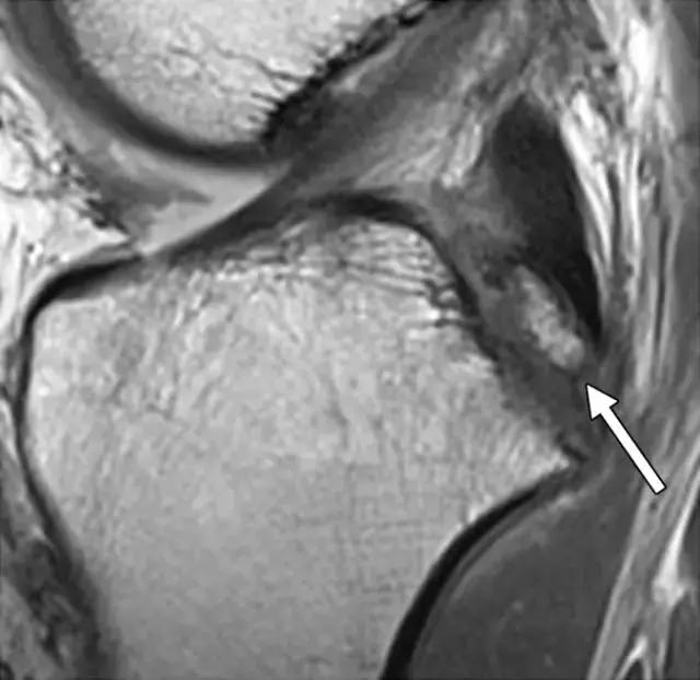 骨折处出现麻痹感,骨折跟精神状态有关