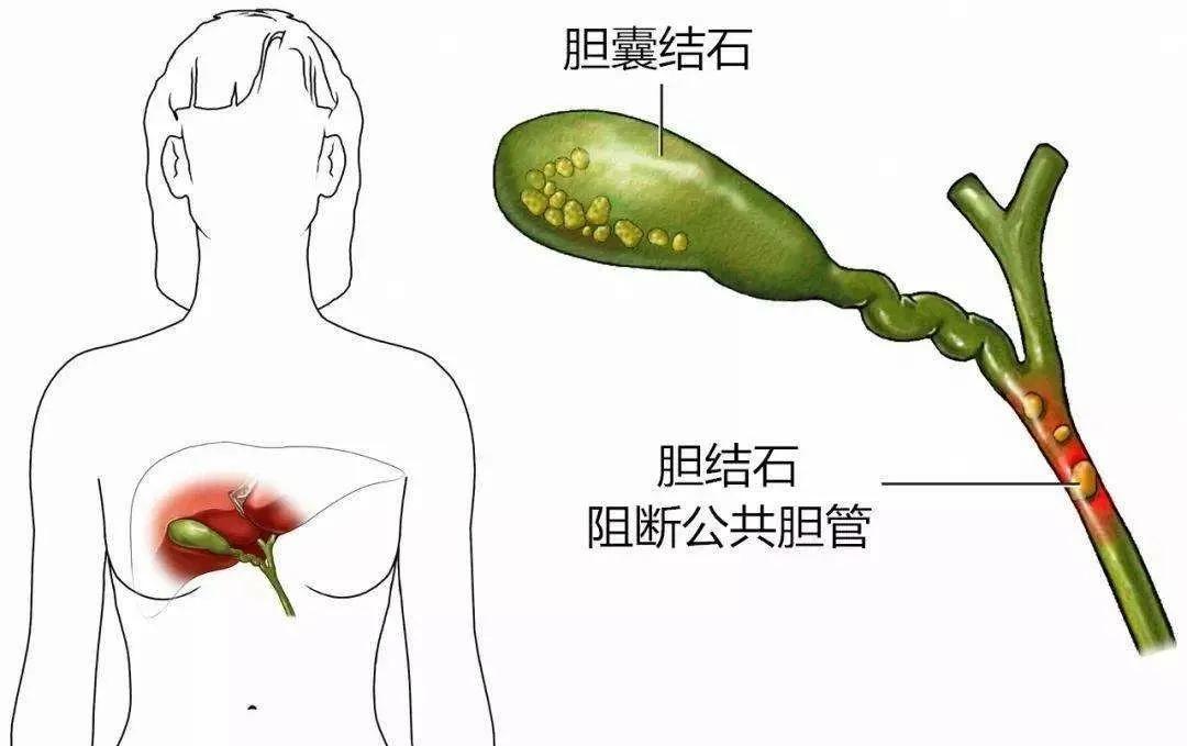 山东齐鲁医院胆囊结石保胆取石,多大的结石可以保胆取石