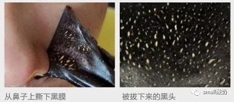 去黑头你真的用对了吗,真的好用的去黑头方法
