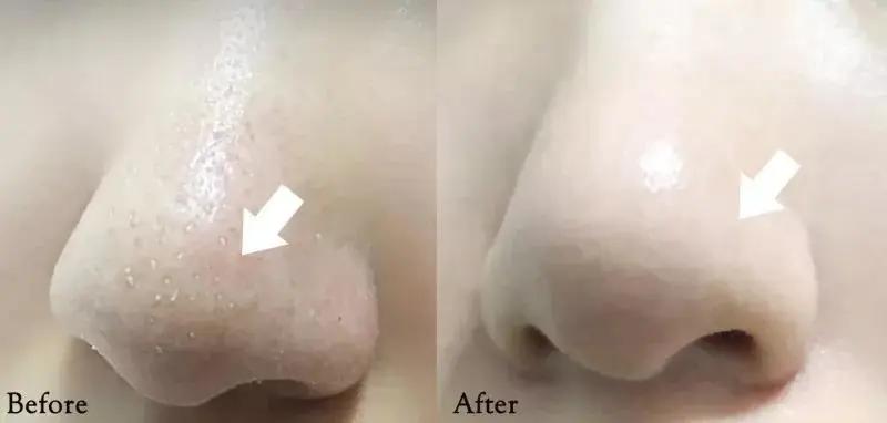 为什么你的痘印总是消不下去,为什么你的祛斑效果不理想