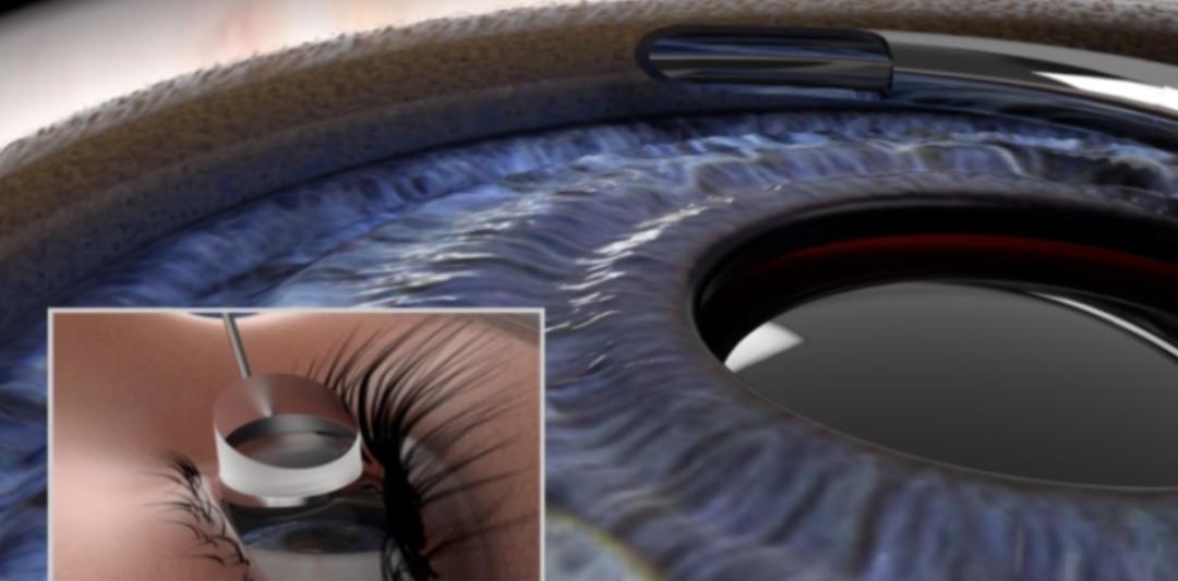 盘点｜十*荣大**获医疗技术突破奖的医疗器械