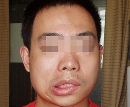 面神经炎最快的恢复办法,面神经炎的症状