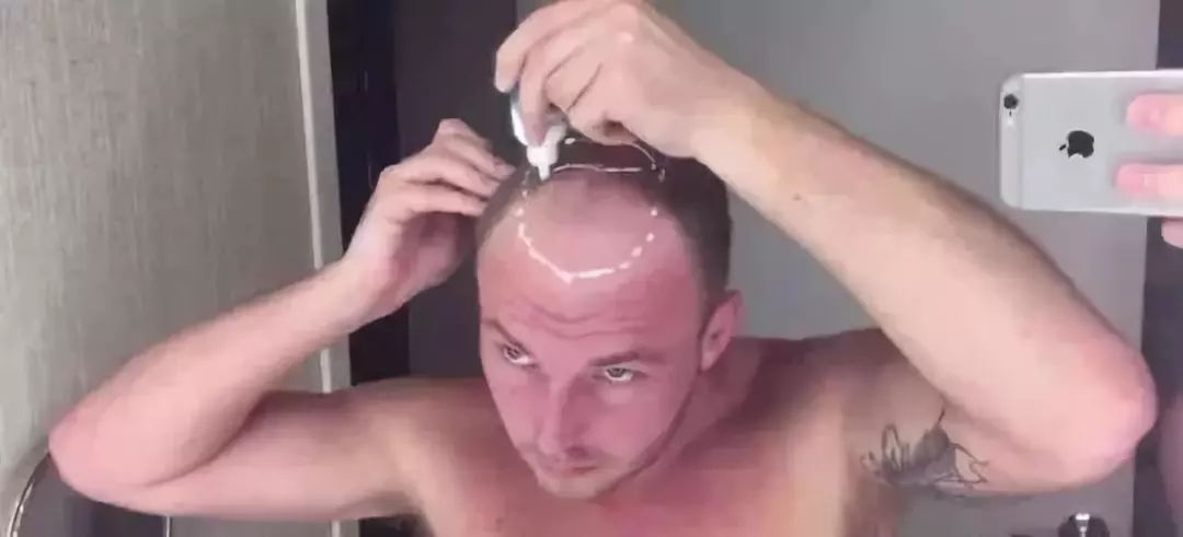 90后没有发际线,90后00后如何不脱发