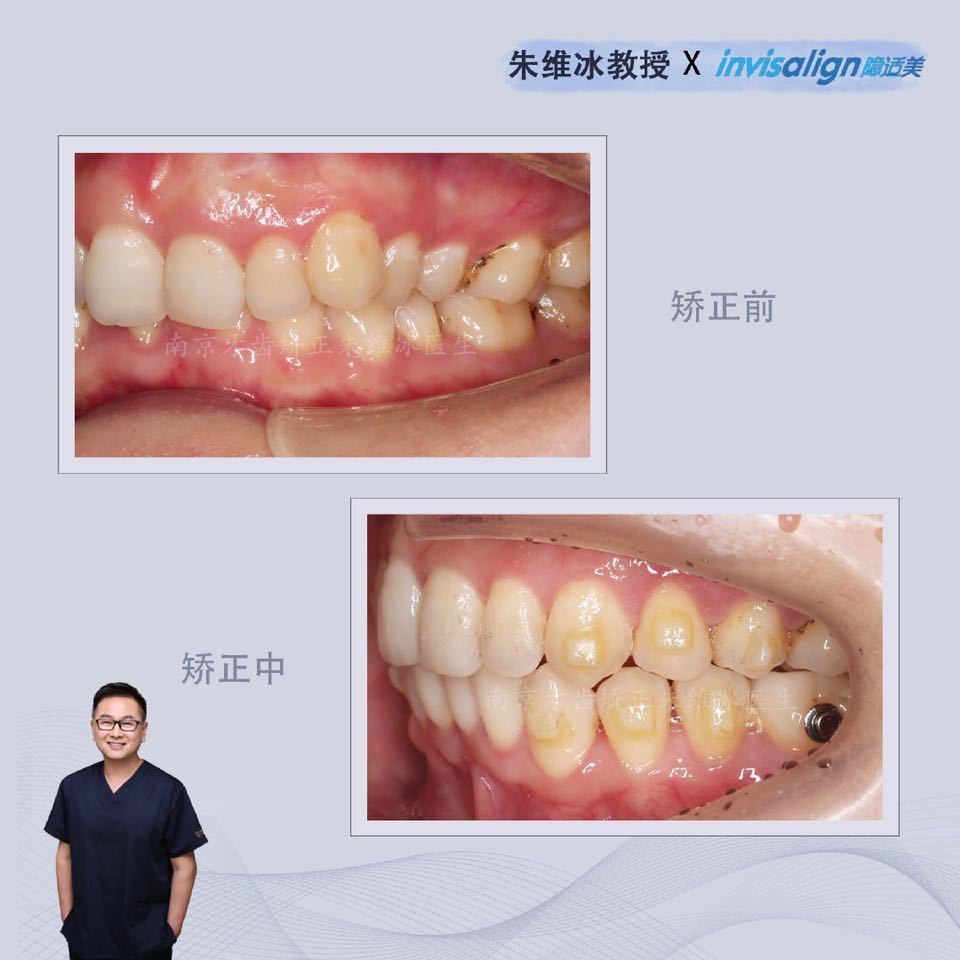 隐适美牙齿拥挤矫正真实案例,南京朱维冰