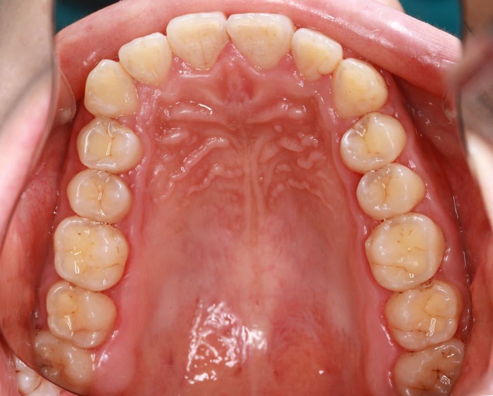 西安张军正畸医生如何,西安牙齿矫正案例