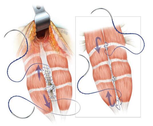 收紧腹部肌肉再现小蛮腰,如何让腹部肌肉快速塑形
