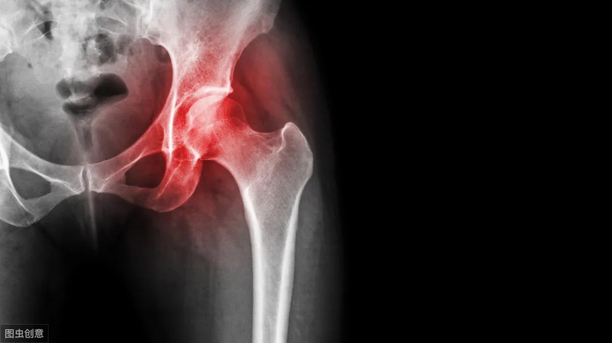 老年人常见骨折部位是髋部骨折吗,髋部骨折保守治疗