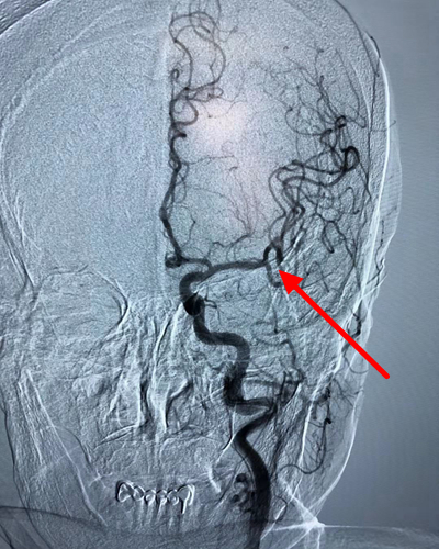脑卒中6小时最佳治疗,延迟性脑梗死