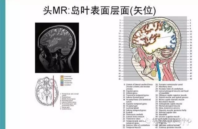 电子版头颅ct与mri断层解剖,头颅mri血管解剖与分段详解